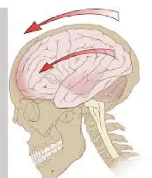 Concussions